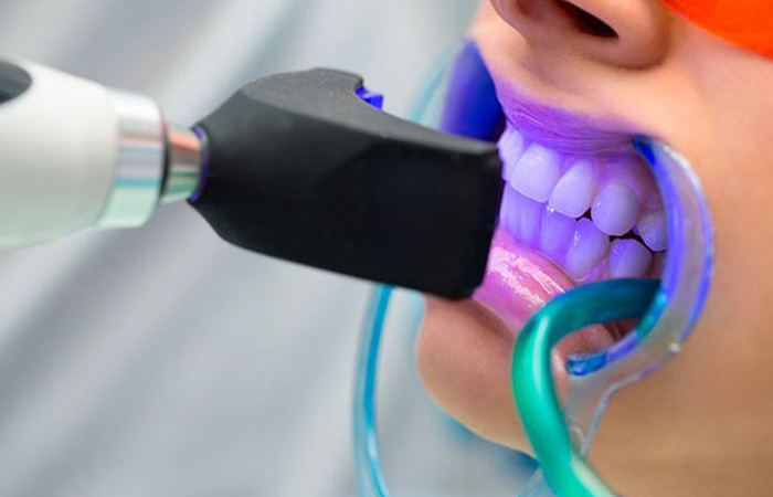 بلیچینگ دندان به چه معنا است و چگونه انجام می‌شود؟