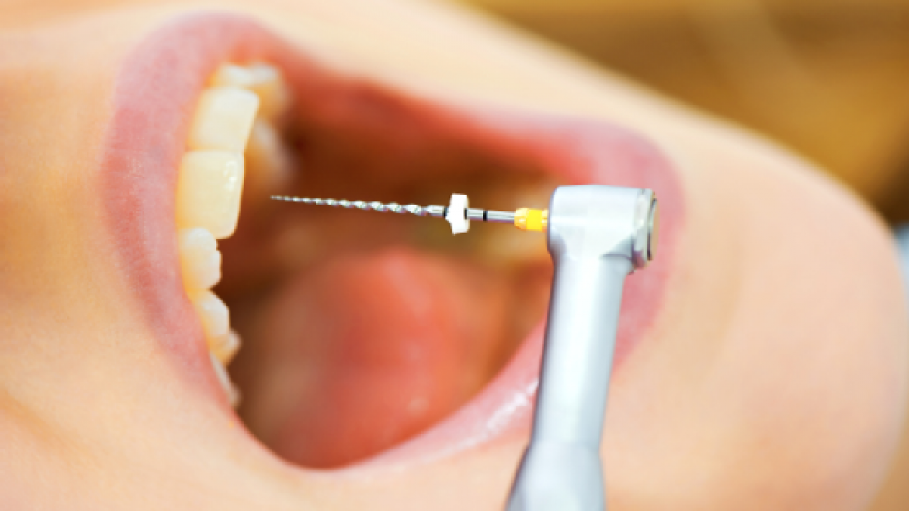 اسپریدر دندانپزشکی