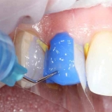اسید هیدروفلوئوریک در دندانپزشکی چیست | کاربرد اسید هیدروفلوئوریک |  اسید هیدروفلوئوریک دندانپزشکی |  ژل اسید هیدروفلوئوریک