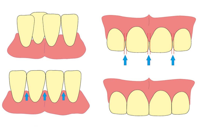 استریپ دندان چیست | عوارض استریپ دندان | استریپ سفید کننده دندان | استریپ دندان در ارتودنسی |  strip دندان در ارتودنسی